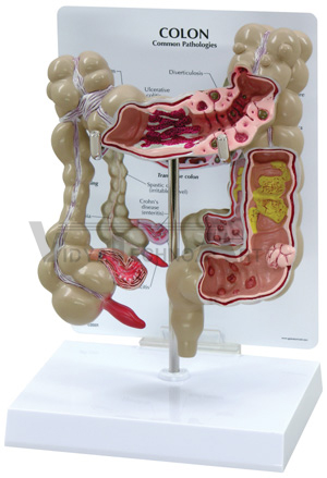 Colon With Pathology